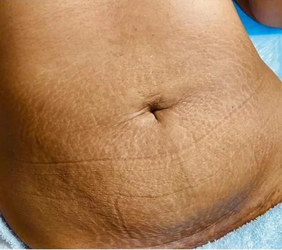 Abdômen antes e depois do tratamento de estrias com MicroPercut — depois