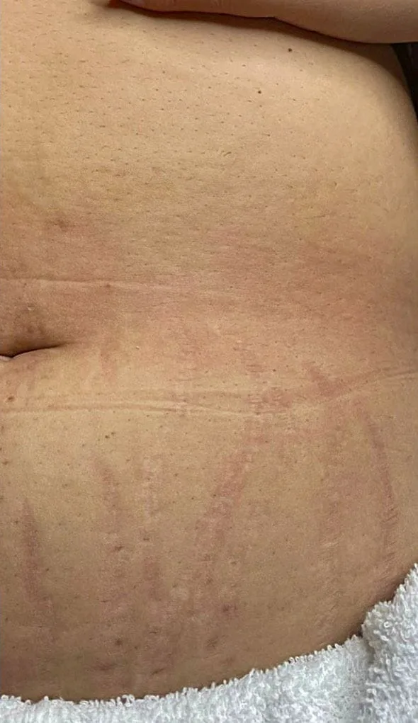 Abdômen inferior antes e depois do tratamento de estrias com MicroPercut — depois