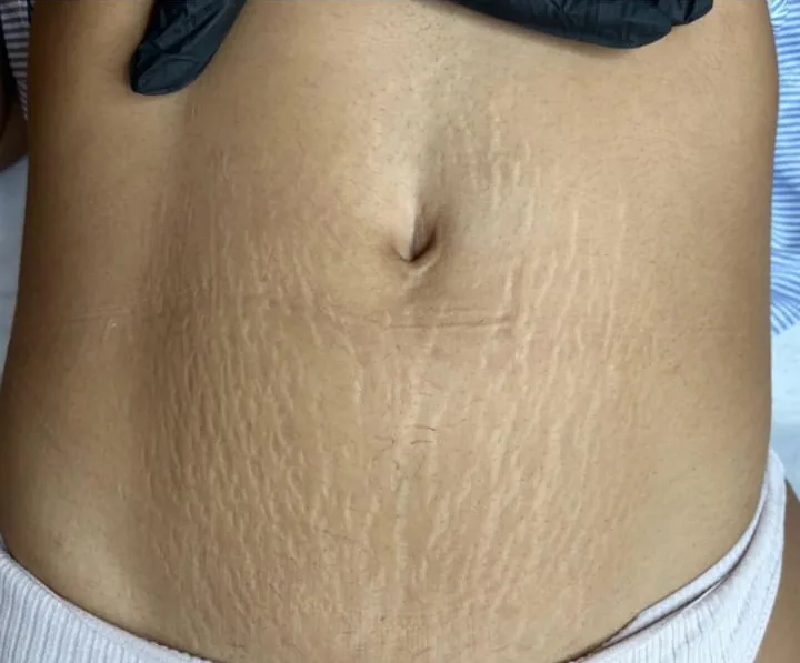 Abdômen antes e depois do tratamento de estrias com MicroPercut — antes