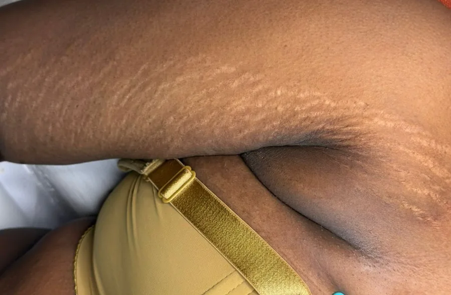 Flancos antes e depois do tratamento de estrias com MicroPercut — antes