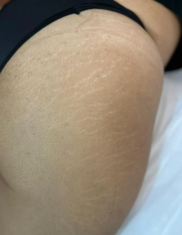 Glúteos antes e depois do tratamento de estrias com MicroPercut — antes